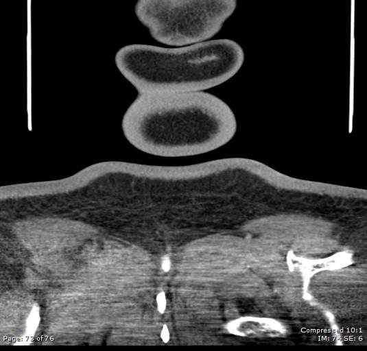 Acute epiglottitis (Radiopaedia 54375-60590 Coronal C+ arterial phase 73).jpg