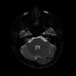 Acute internal carotid artery dissection (Radiopaedia 53541-59632 Axial DWI 39).jpg