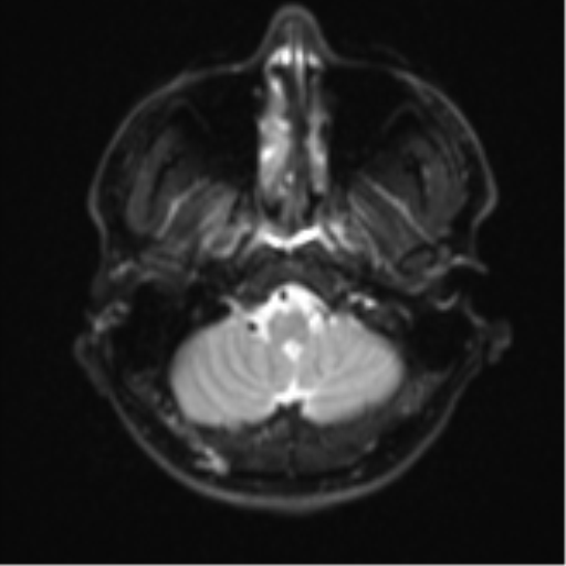 Acute left middle cerebral artery territory infarct with clot retrieval (Radiopaedia 47732-52433 Axial DWI 4).png