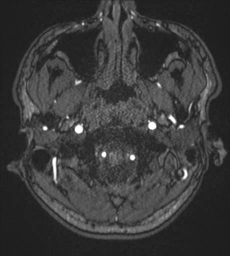 Acute left middle cerebral artery territory infarct with clot retrieval (Radiopaedia 47732-52433 Axial MRA 1).png