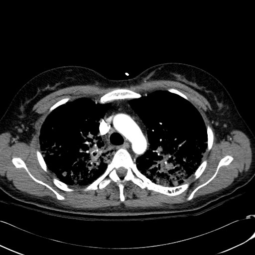 Acute myocardial infarction in CT (Radiopaedia 39947-42415 Axial C+ arterial phase 39).jpg