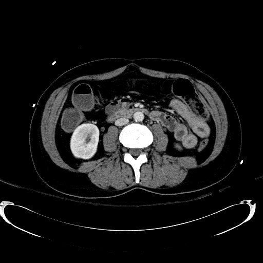 File:Acute myocardial infarction in CT (Radiopaedia 39947-42415 Axial C+ portal venous phase 66).jpg