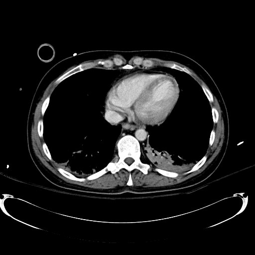 File:Acute myocardial infarction in CT (Radiopaedia 39947-42415 Axial C+ portal venous phase 9).jpg