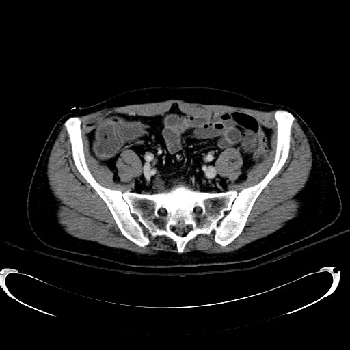 Acute myocardial infarction in CT (Radiopaedia 39947-42415 Axial C+ portal venous phase 98).jpg