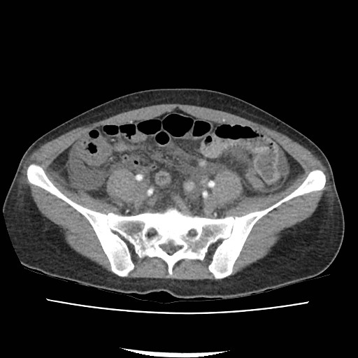 File:Acute myocarditis (Radiopaedia 55988-62613 Axial C+ portal venous phase 56).jpg