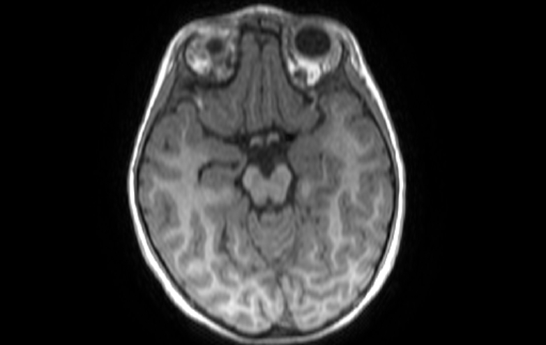 File:Acute necrotizing encephalitis of childhood (Radiopaedia 67356-76737 Axial T1 60).jpg