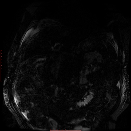 File:Acute necrotizing pancreatitis (Radiopaedia 28194-28448 Coronal MRCP 65).jpg