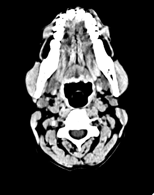 Acute on chronic subdural hematoma (Radiopaedia 74814-85823 Axial non-contrast 12).jpg