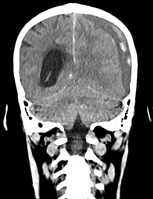 Acute on chronic subdural hematoma (Radiopaedia 74814-85823 Coronal non-contrast 45).jpg