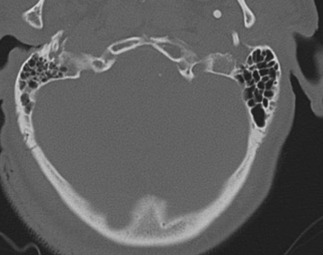 Acute on chronic subdural hematoma and thoracic vertebral injury in a multitrauma patient (Radiopaedia 31698-32619 Axial bone window 7).jpg