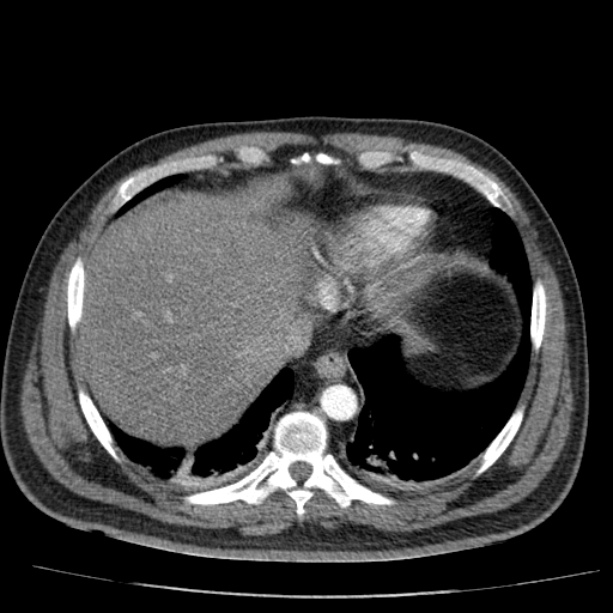 Acute pancreatitis (Radiopaedia 26663-26813 Axial C+ arterial phase 15).jpg
