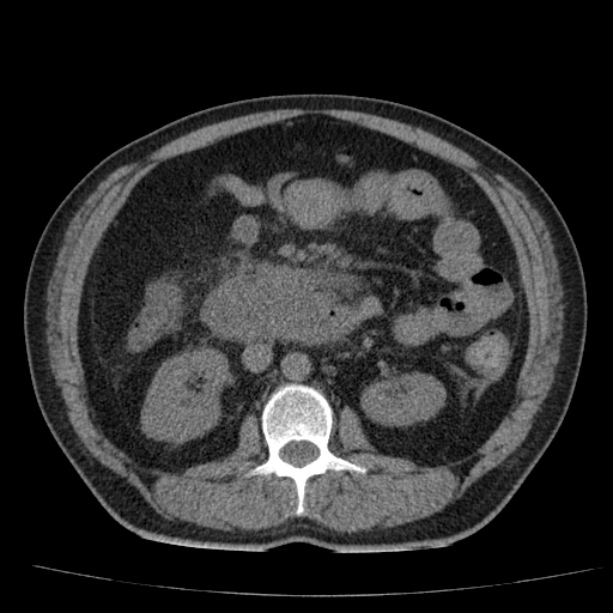 Acute pancreatitis (Radiopaedia 26663-26813 Axial non-contrast 48).jpg