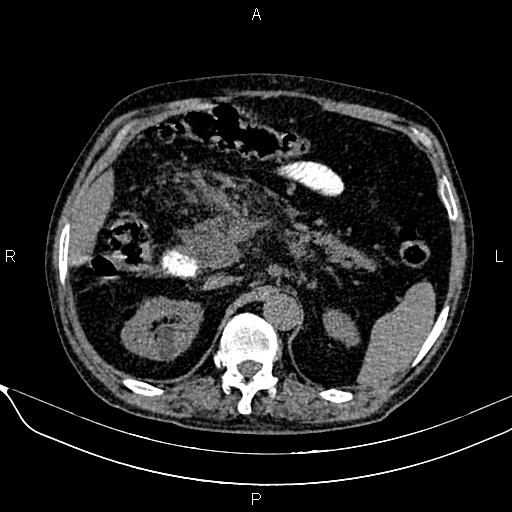Acute pancreatitis (Radiopaedia 85146-100701 Axial non-contrast 43).jpg