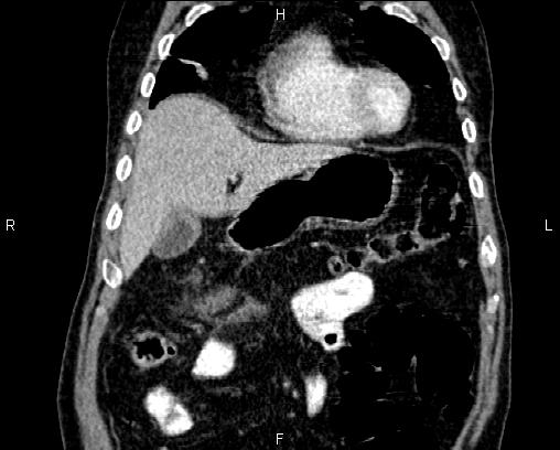 Acute pancreatitis (Radiopaedia 85146-100701 Coronal C+ portal venous phase 15).jpg