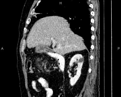 Acute pancreatitis (Radiopaedia 85146-100701 Sagittal C+ portal venous phase 26).jpg