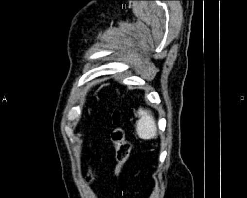 File:Acute pancreatitis (Radiopaedia 85146-100701 Sagittal C+ portal venous phase 91).jpg