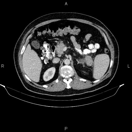 File:Acute pancreatitis (Radiopaedia 85390-101010 Axial C+ portal venous phase 36).jpg