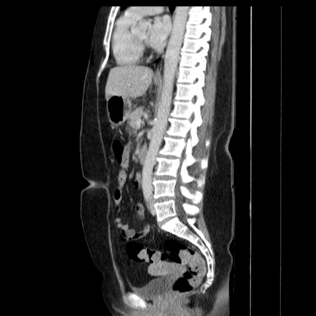 Acute pancreatitis - Balthazar C (Radiopaedia 26569-26714 Sagittal C+ portal venous phase 37).jpg