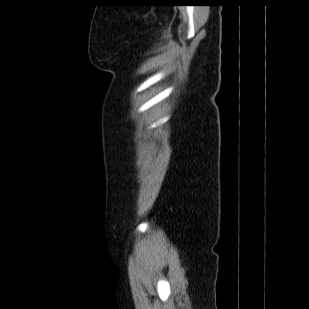 Acute pancreatitis - Balthazar C (Radiopaedia 26569-26714 Sagittal C+ portal venous phase 9).jpg