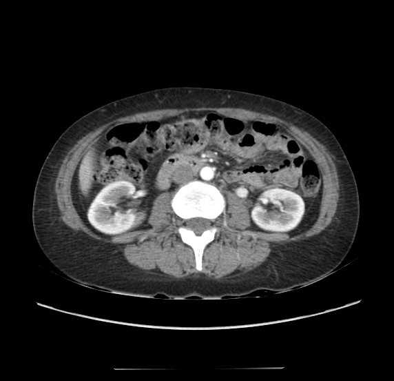 File:Acute pancreatitis - Balthazar E - post ERCP (Radiopaedia 27562-27772 Axial C+ arterial phase 30).png