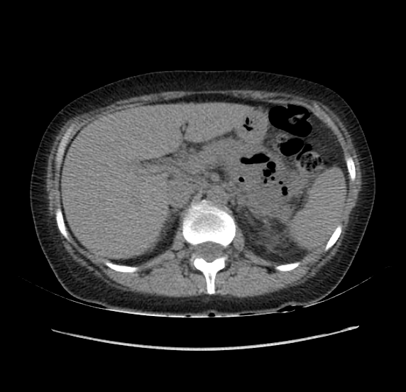 File:Acute pancreatitis - Balthazar E - post ERCP (Radiopaedia 27562-27772 Axial non-contrast 17).png