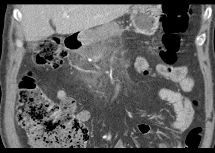 Acute pancreatitis and walled-off necrosis (Radiopaedia 29888-30403 Coronal C+ portal venous phase 21).jpg