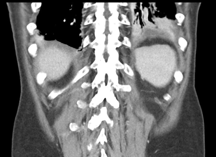 Acute pancreatitis and walled-off necrosis (Radiopaedia 29888-30404 Coronal C+ portal venous phase 44).jpg