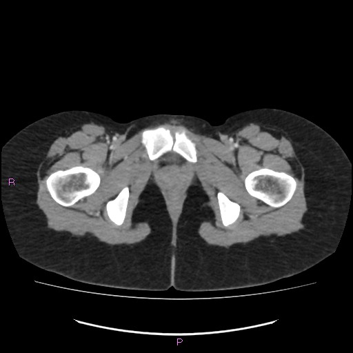 File:Acute pancreatitis secondary to stone at minor papilla and pancreatic divisum (Radiopaedia 76570-88333 Axial C+ portal venous phase 84).jpg