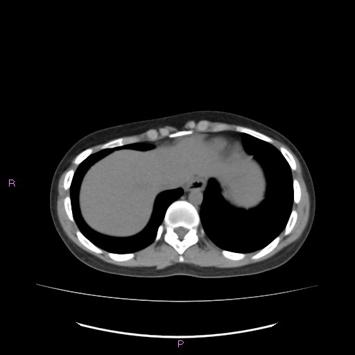 Acute pancreatitis secondary to stone at minor papilla and pancreatic divisum (Radiopaedia 76570-88333 Axial non-contrast 9).jpg