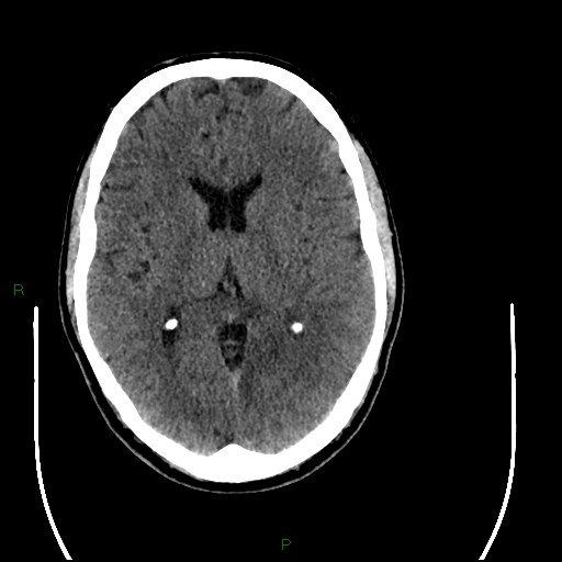 Acute posterior cerebral artery territory infarct (Radiopaedia 79329-92393 Axial non-contrast 57).jpg