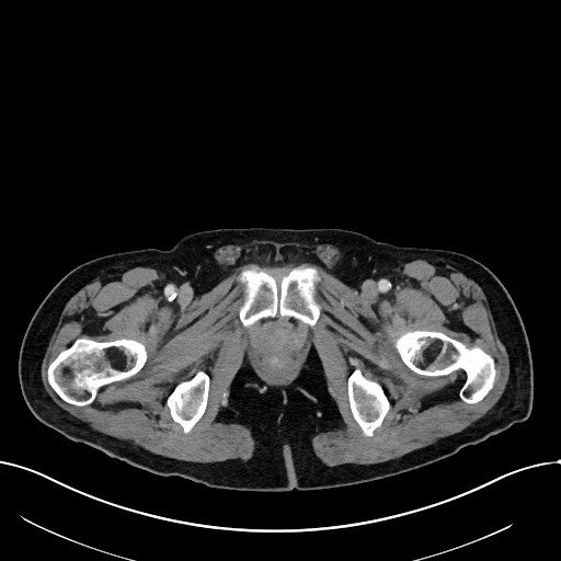 File:Acute renal infarction (Radiopaedia 59375-66736 Axial C+ portal venous phase 123).jpg