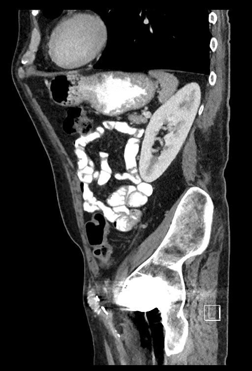 Acute renal infarction - rim capsular enhancement (Radiopaedia 59833-67270 Sagittal C+ portal venous phase 28).jpg