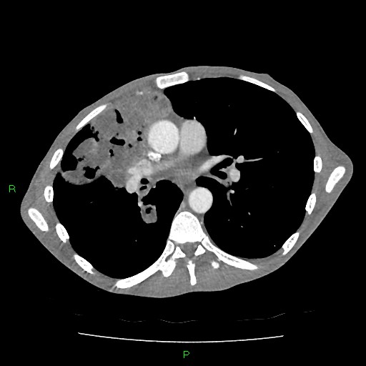 File:Acute right lung abscess (Radiopaedia 34806-36258 Axial C+ arterial phase 92).jpg
