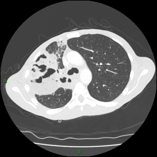 Acute right lung abscess (Radiopaedia 34806-36258 Axial lung window 64).jpg