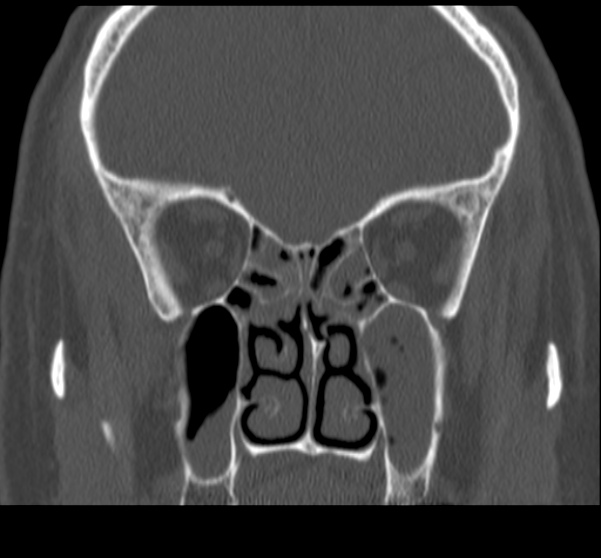 File:Acute sinusitis (Radiopaedia 23161-23215 Coronal bone window 39).jpg