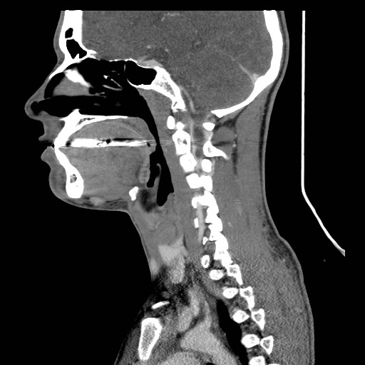 File:Acute submandibular sialadenitis secondary to ductal stone (Radiopaedia 27999-28267 Sagittal C+ delayed 25).jpg