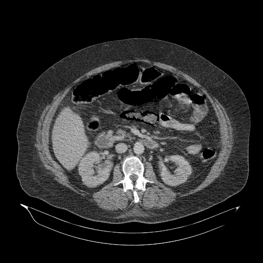 File:Acute superior mesenteric artery occlusion (Radiopaedia 51288-56960 Axial C+ portal venous phase 44).jpg
