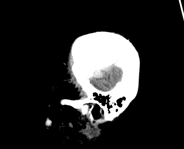File:Acute traumatic subdural hematoma (Radiopaedia 82921-97257 Sagittal non-contrast 12).jpg