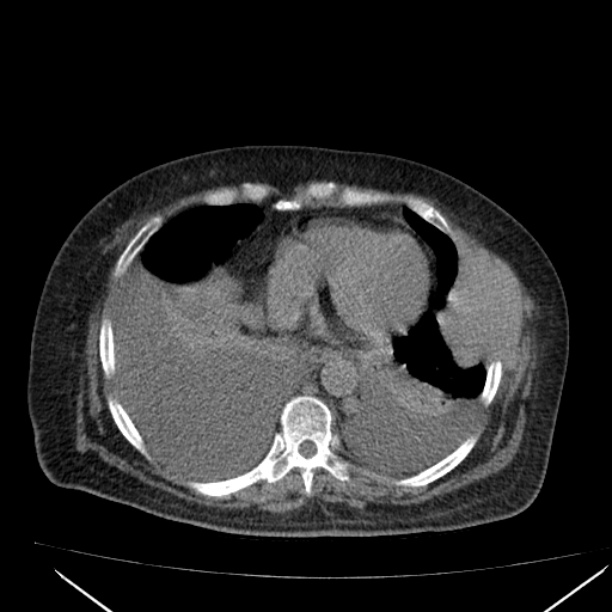 Acute tubular necrosis (Radiopaedia 28077-28334 Axial non-contrast 7).jpg
