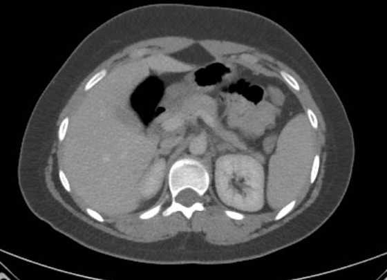Acute unilateral nonhemorrhagic adrenal infarction (Radiopaedia 67560-76957 Axial renal parenchymal phase 39).jpg