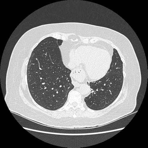 Adenocarcinoma in situ of lung (Radiopaedia 38685-40829 B 161).png