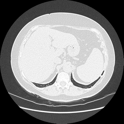 Adenocarcinoma in situ of lung (Radiopaedia 38685-40829 B 209).png