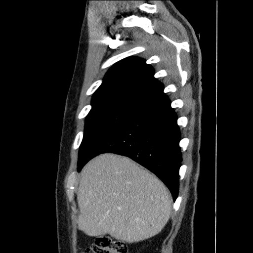 Adenocarcinoma of the lung (Radiopaedia 59871-67325 Sagittal C+ arterial phase 13).jpg