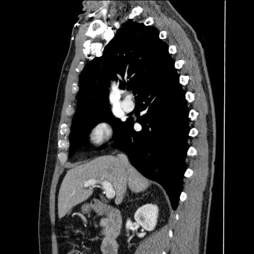 Adenocarcinoma of the lung (Radiopaedia 59871-67325 Sagittal C+ arterial phase 38).jpg
