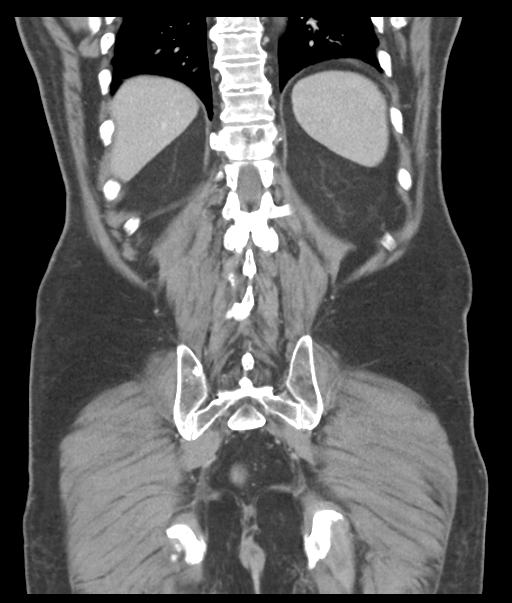 Adenocarcioma of rectum- T1 lesion (Radiopaedia 36921-38547 Coronal C+ portal venous phase 50).png