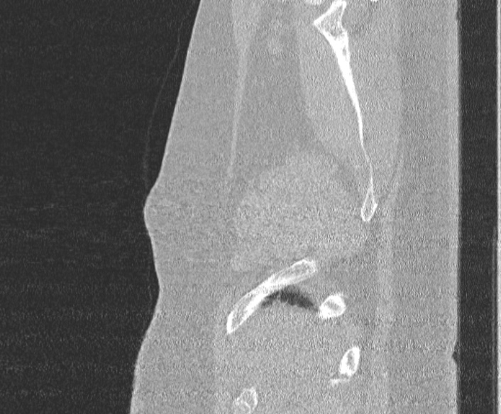 Adenoid cystic carcinoma of the trachea (Radiopaedia 49042-54137 Sagittal lung window 26).jpg