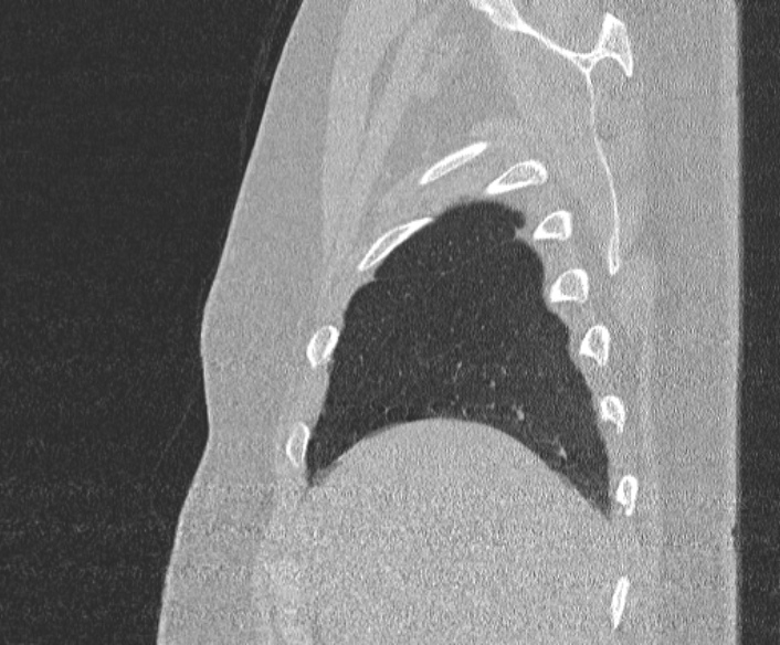 Adenoid cystic carcinoma of the trachea (Radiopaedia 49042-54137 Sagittal lung window 65).jpg