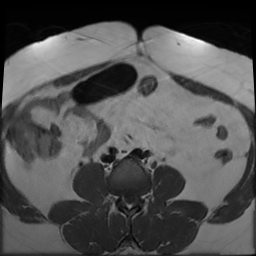 File:Adenomyosis within a didelphys uterus (Radiopaedia 70175-80215 Axial T1 7).jpg