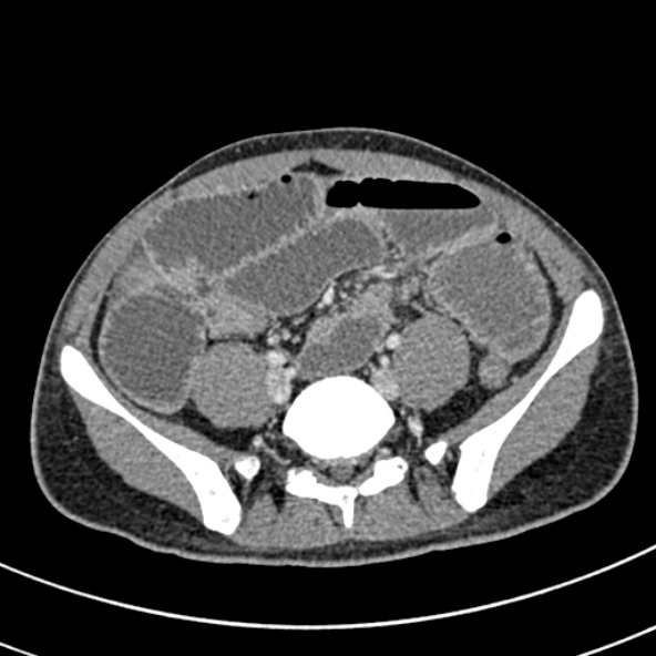 Adhesional small bowel obstruction (Radiopaedia 52107-57980 Axial C+ portal venous phase 88).jpg