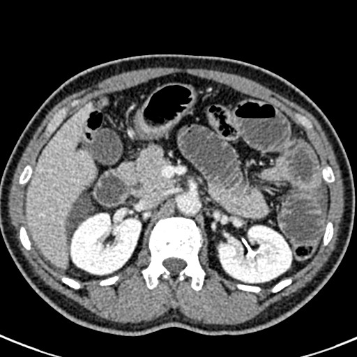 Adhesional small bowel obstruction (Radiopaedia 58900-66131 Axial C+ portal venous phase 18).jpg